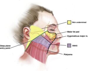 deep plane facelift
