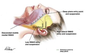 traditional facelifts versus deep plane facelift